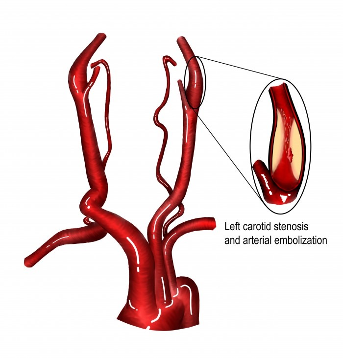 Understanding Carotid Stenosis: Protecting Against Stroke